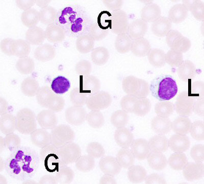 Blutprobe mit weissen Blutkörperchen: Lymphocytes (L) und Granulocytes (G)