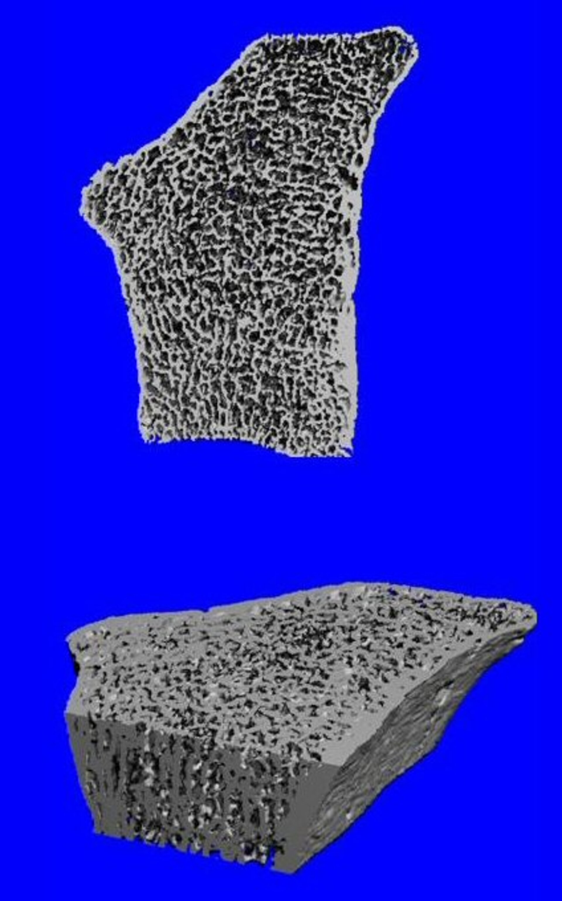 pQCT-Aufnahme osteoporotischer Knochen in 3D