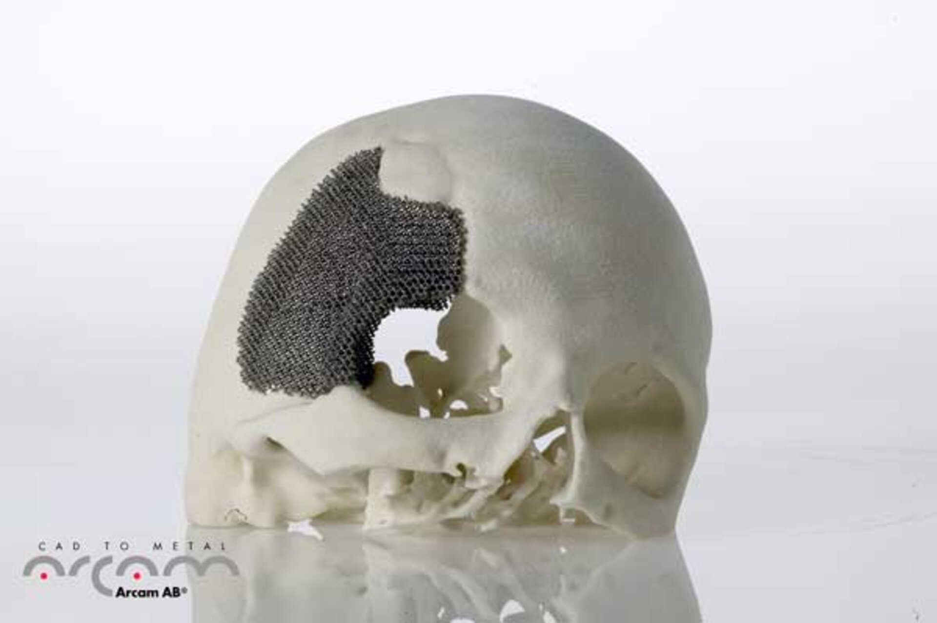 3D-printed skull implant