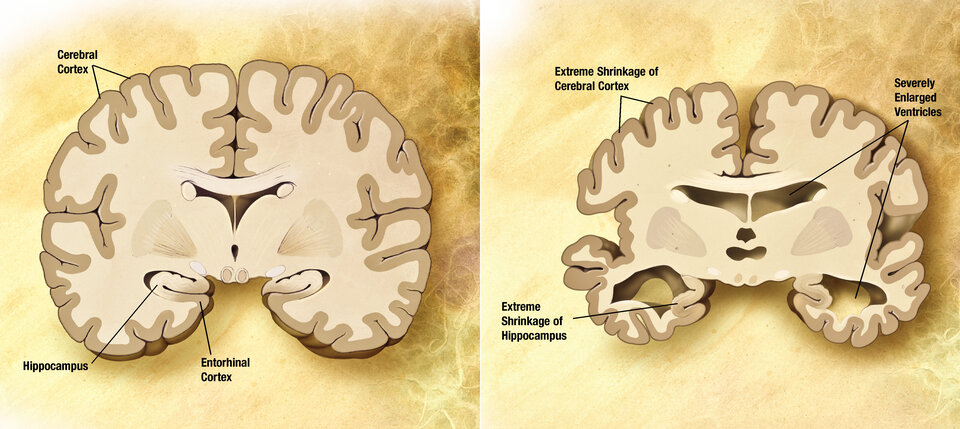 Δεξιά: Εγκέφαλος με τη νόσο Αλτσχάιμερ