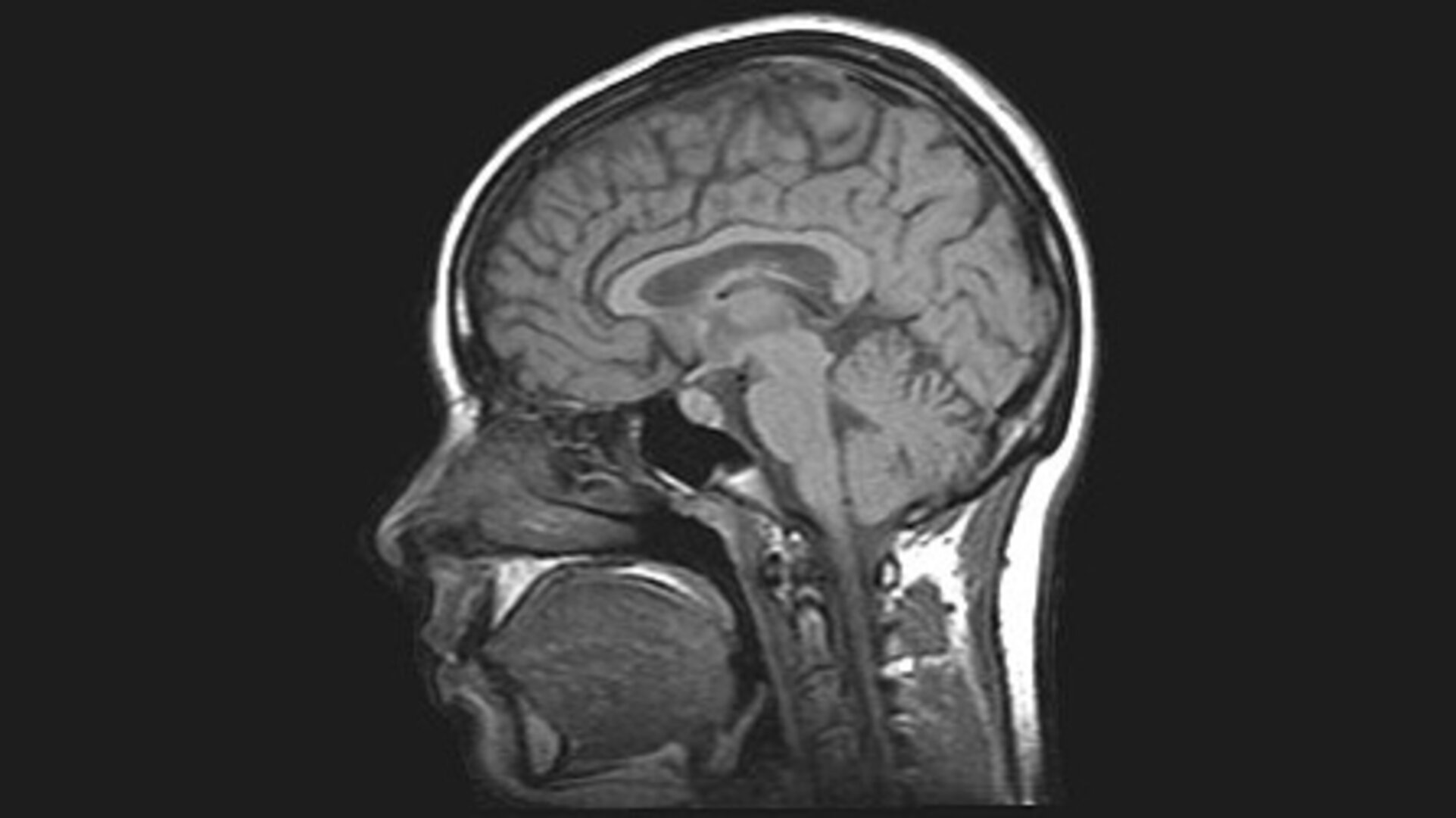 Σάρωση εγκεφάλου MRI