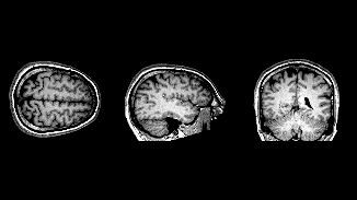 MRI showing progressive brain scan in 3 planes