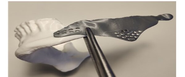 Biomedical Implant in Additive Manufacturing