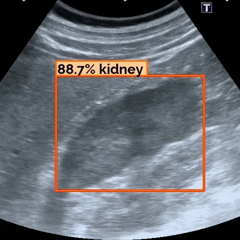 Applying AI to ultrasound exams